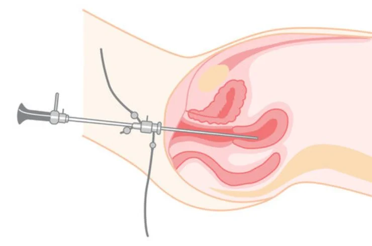 Hysteroscopy
